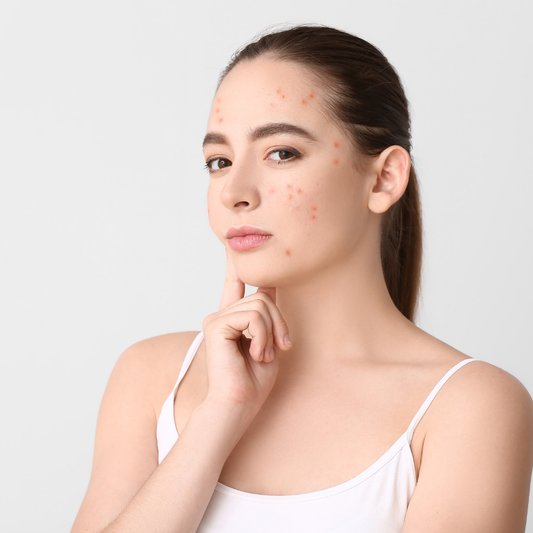 Tratament Antiacnee IPL 3D pentru Curățare, Regenerare și Control Sebum