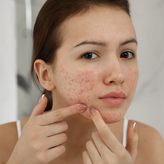 Tratament Antiacnee IPL 3D pentru Curățare, Regenerare și Control Sebum