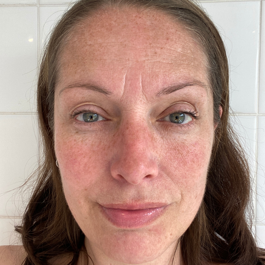 Tratament Pete Pigmentare IPL 3D pentru Uniformizare și Luminozitate Vizibilă