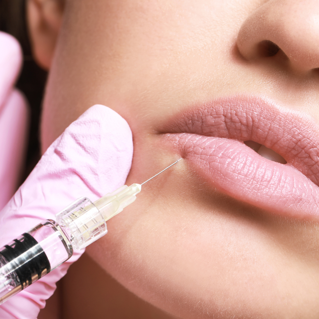 Augmentare Buze cu Acid Hialuronic Amalian pentru Volum Elegant și Hidratare