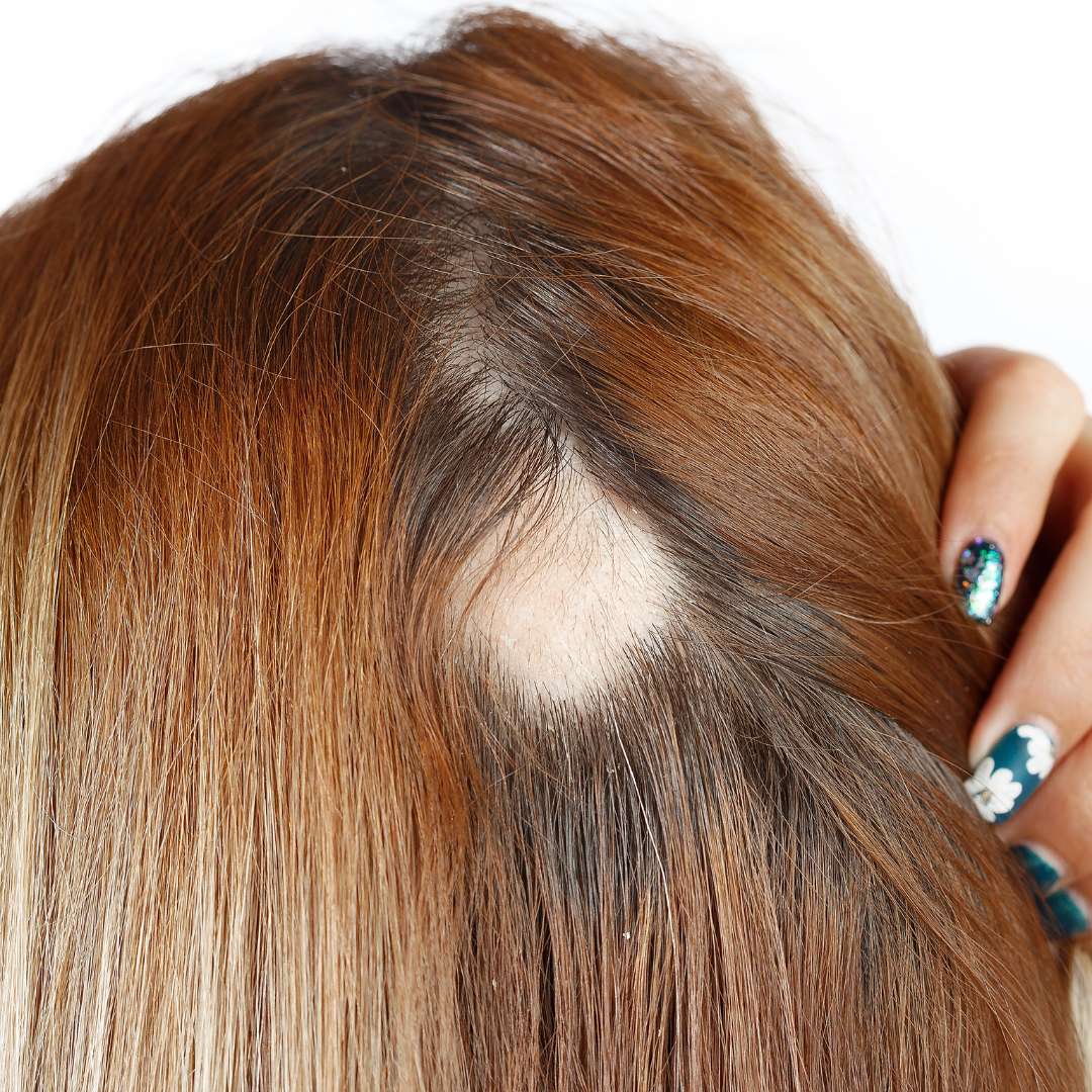 Test ADN Cădere Păr TrichoTest SharpGenetics pentru Tratamente Personalizate Anti-Alopecie