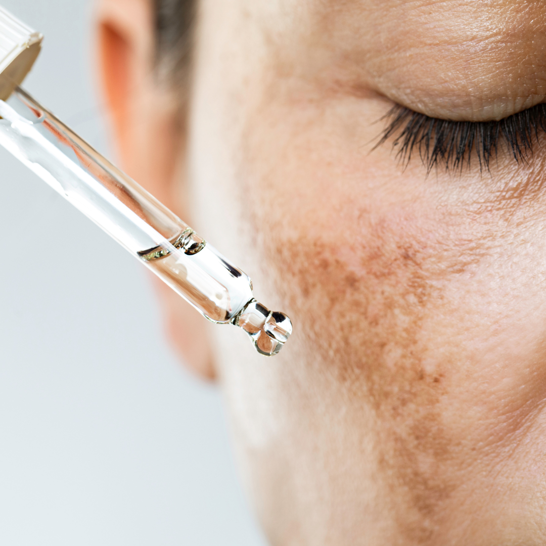 Tratament pete pigmentare IPL 3D pentru uniformizarea tenului la aBeauty Clinique