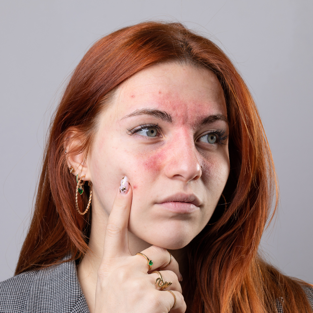 Tratament pentru vase capilare vizibile realizat într-o clinică aBeauty Clinique