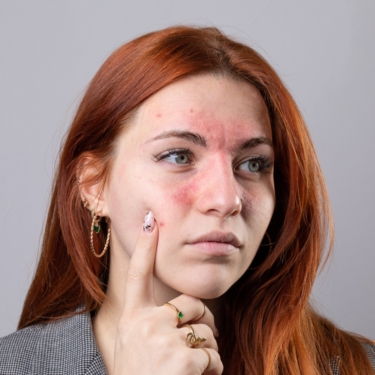 Tratament pentru vase capilare vizibile realizat într-o clinică aBeauty Clinique