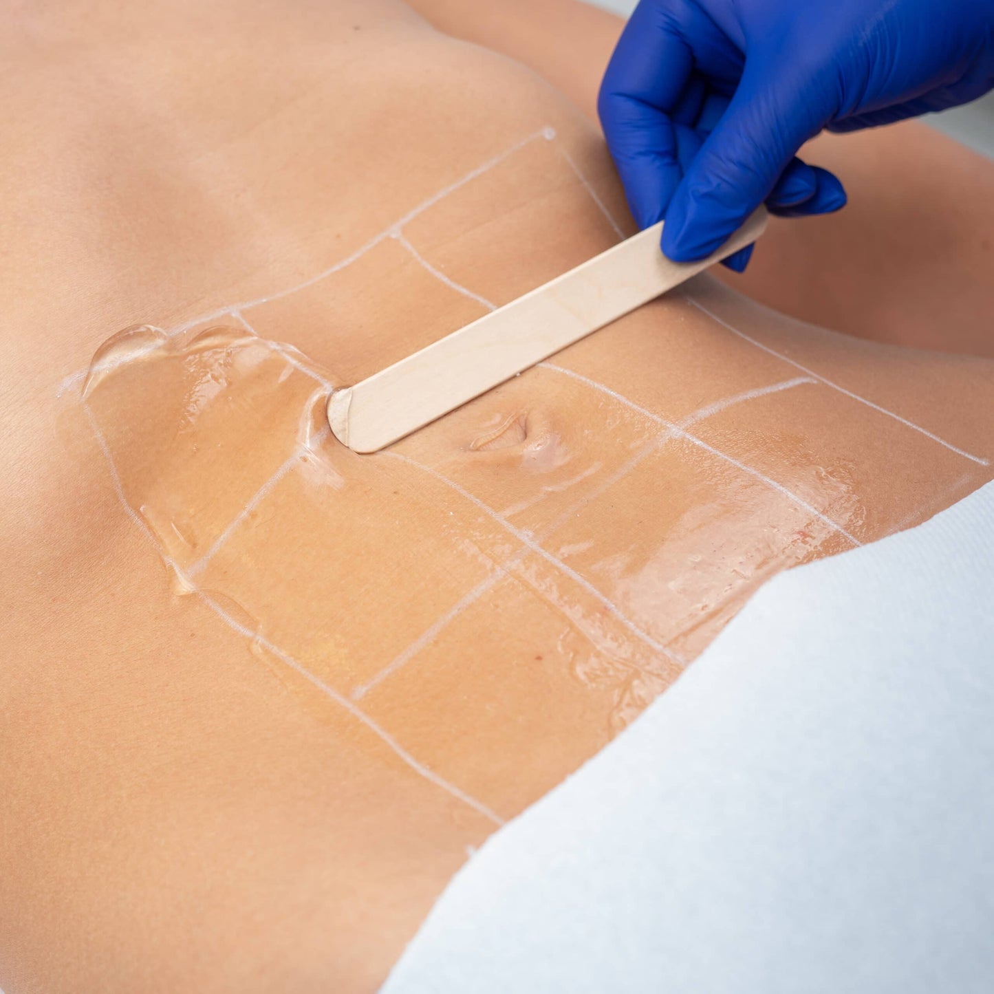 Tratament corporal pe zona abdomenului la aBeauty Clinique