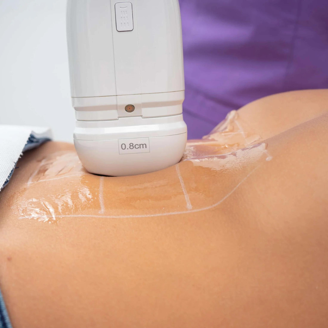 Pachet 12 Ședințe de Tratamente Corporale B-Complexity ® Adiposity Intervention