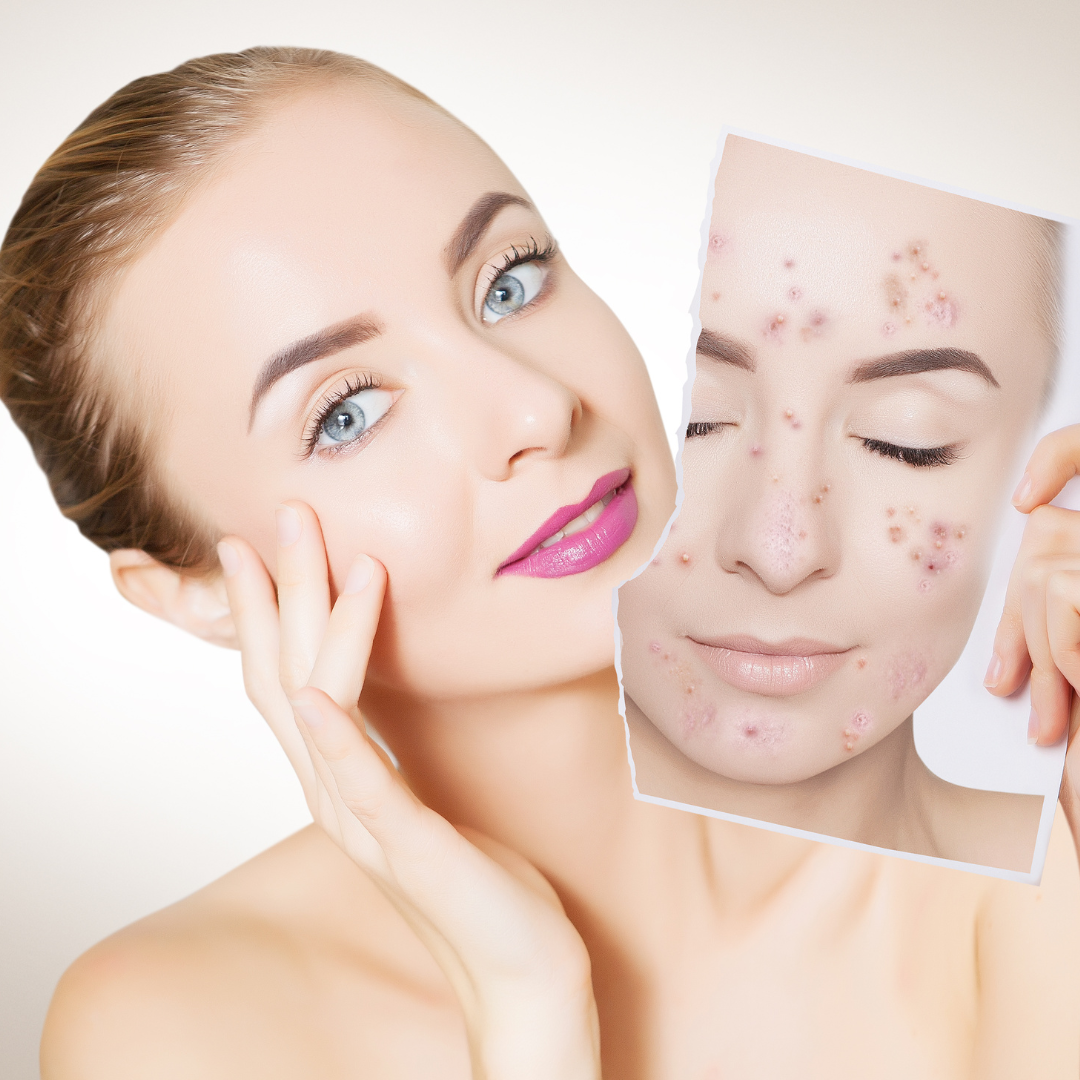 Test genetic pentru piele cu acnee la aBeauty Clinique