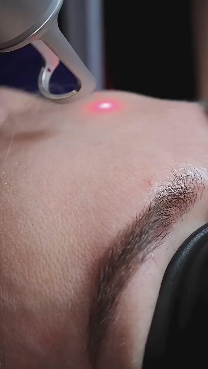 Laserul Nd:YAG pe roșeață și vase fine, în clinica aBeauty