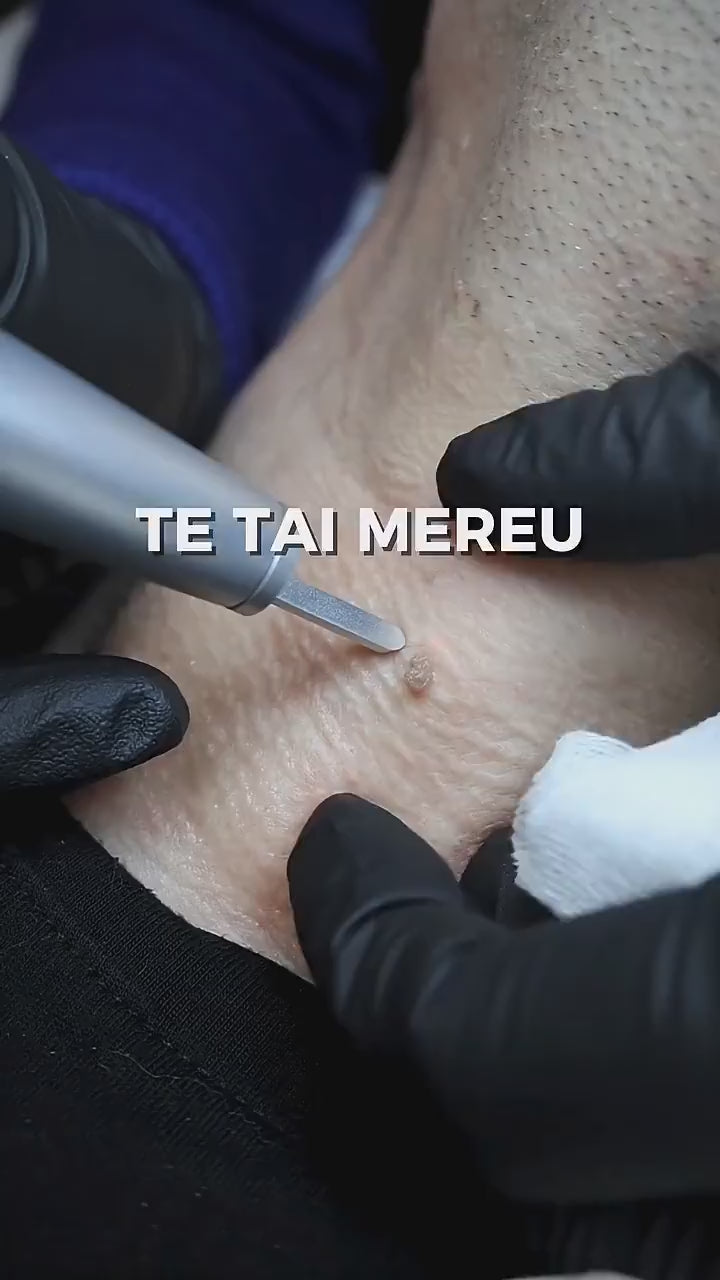 Papiloame pe gât îndepărtate cu laserul CO2, în clinica aBeauty
